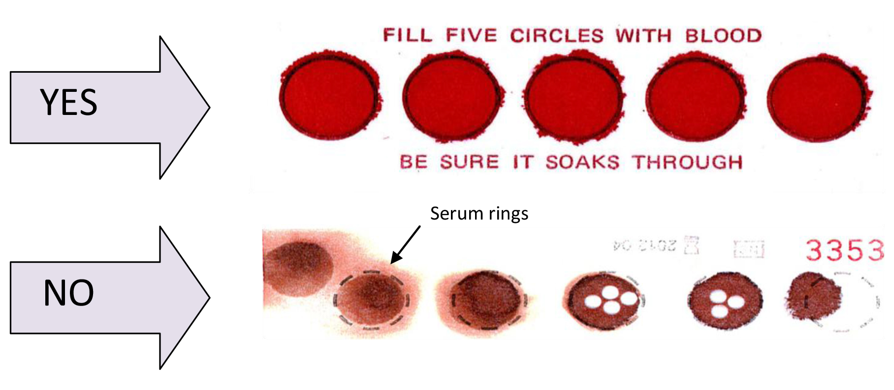 an illustration showing the correct and incorrect ways the five circles should be filled with blood